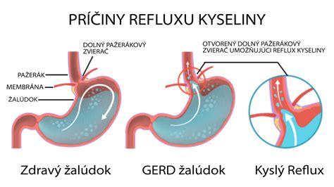 Infografika: Ako funguje dolný pažerákový zvierač a reflux