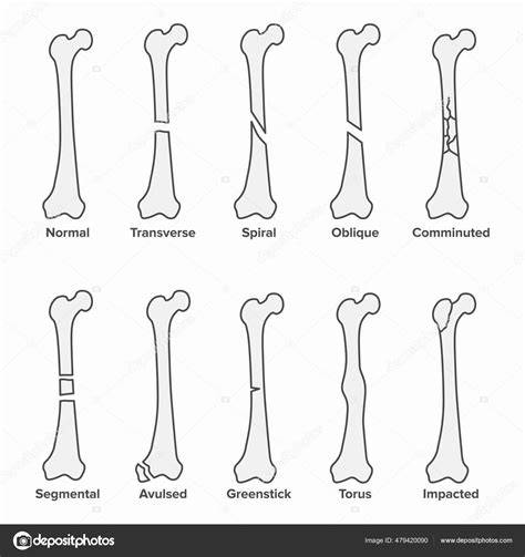 Infografika: Špirálová zlomenina stehnej kosti a liečebný proces