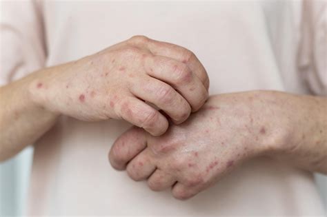 Dojčenie a svrab u matky: liečba a bezpečnosť v období dojčenia