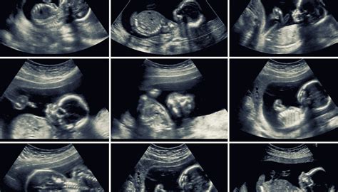 Ultrazvukové zobrazenie plodu v 16. týždni tehotenstva