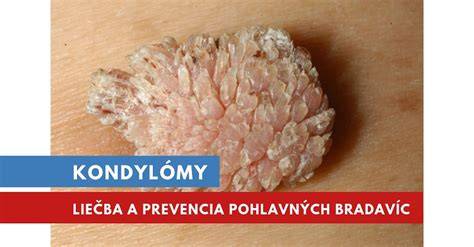 Infografika: HPV a genitálne bradavice - štruktúra, prenos a prevencia