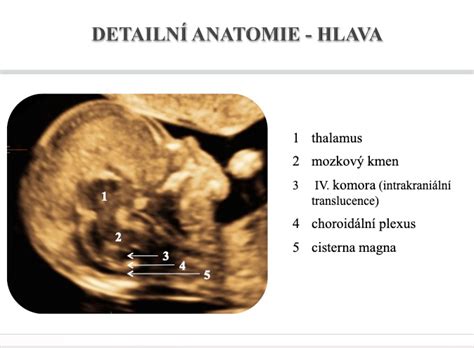 Ultrazvukové zobrazenie hlavičky plodu s vyznačenými laterálnymi komorami