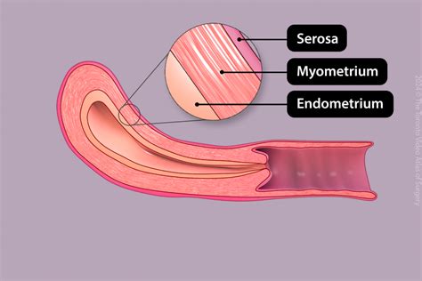 Infografika znázorňujúca vrstvy maternice: endometrium, myometrium, peritoneum