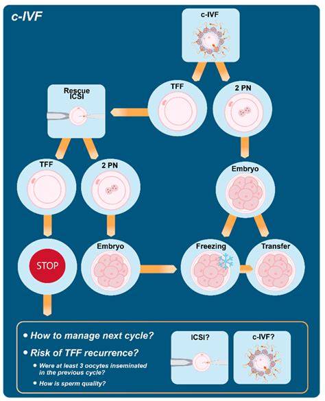 Infografika znázorňujúca kroky IVF: stimulácia vaječníkov, odber vajíčok, ICSI, kultivácia, embryotransfer