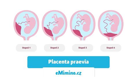 Riziká nízko uloženej placenty a odporúčaný režim