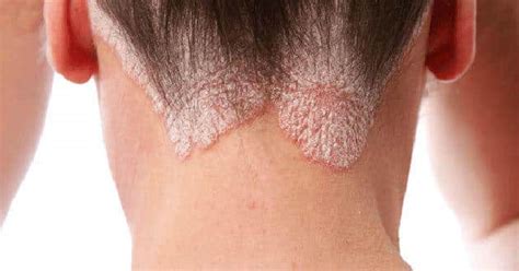 Seboroická dermatitída u bábätka