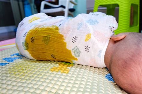 Vývoj lanugo u novorodenca