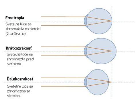 Infografika: Krátkozrakosť, ďalekozrakosť a astigmatizmus