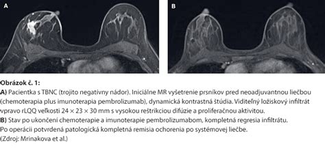 Infografika: Cysty prsníka a ich diagnostika