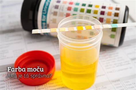 Vplyv HCG na farbu moču: čo potrebujete vedieť