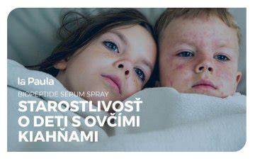 Bezpečné tipy pri starostlivosti o deti s ovčími kiahňami