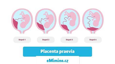 Infografika: typy placenty praevia a ich riziká pre pôrod