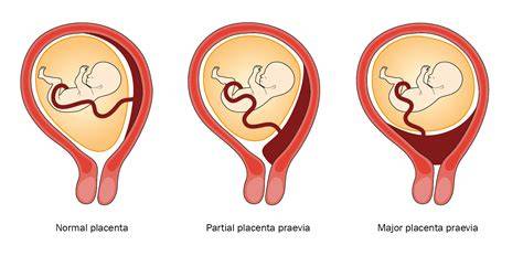 Placenta praevia marginalis: príznaky a liečba