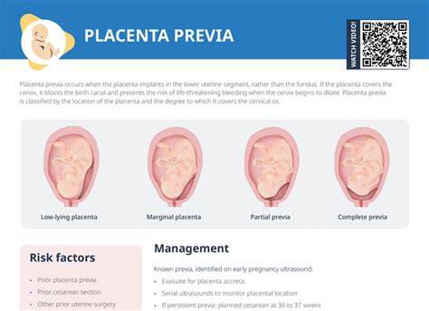 Infografika znázorňujúca placentu previa, placenta accreta a riziká počas pôrodu