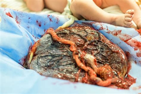 Čo znamená placenta na zadnej stene maternice a aké sú riziká vrastenej placenty