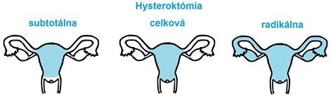 Hysteroskopická polypektómia: vizualizácia dutiny maternice a odstránenie polypov