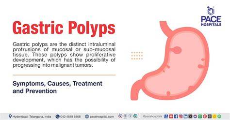 Infografika: Diely maternice a polypu, typy stopkajtý a prisadnutý polyp