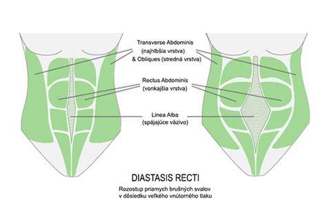 Infografika: Diastáza brušných svalov a význam zapojenia svalového korzetu