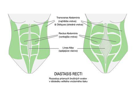 Infografika: brušná diastáza a zotavenie po pôrode