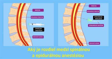 Infografika: Ako funguje epidurálna analgézia
