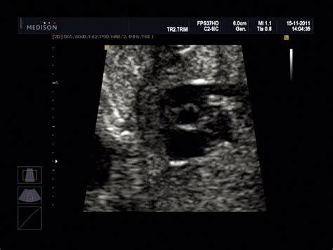 Morfologický ultrazvuk v Dunajskej Strede: Informácie a odborné znalosti