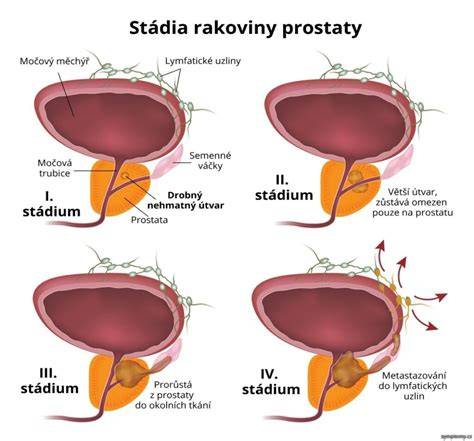 Vplyv liečby rakoviny prostaty na plodnosť muža