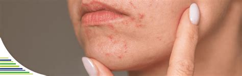 Infografika: čo spôsobuje periorálnu dermatitídu a ako ju rozpoznať