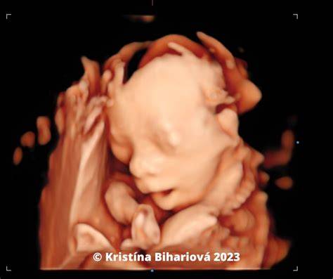 3D zobrazenie plodu a ukážka trojrozmerného zobrazenia