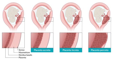 Infografika o rizikách konzumácie placenty