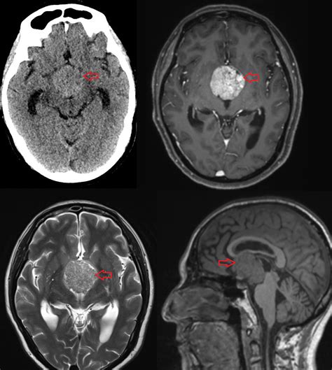 Štruktúra hypofýzy a jej vzťah k mozgu