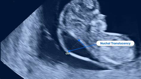 Ikonická schéma: šijové presvietenie (nuchal translucency), dopplerové mapovanie