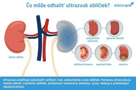 Infografika: Ako prebieha ultrazvuk obličiek a dopplerovské vyšetrenie