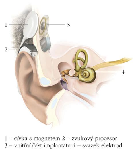 Schéma kochleárneho implantátu a stimulácie sluchu