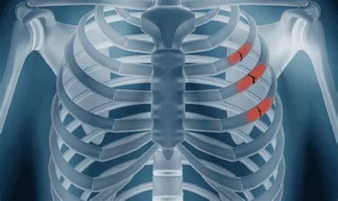 infografika_schem_vzor_broken_rib