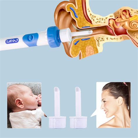 Bezpečné a efektívne odstraňovanie ušného mazu: Sprievodca