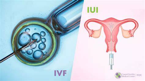 Infografika: Rozdiel medzi IUI a IVF