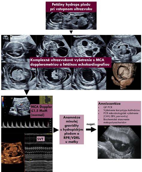 Schéma postupnosti ultrazvukového vyšetrenia: príprava - aplikácia gelu - sonograf - vyhodnotenie výsledkov - komunikácia s pacientom