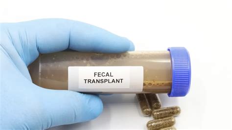 Schéma fungovania fekálnej mikrobiálnej transplantácie