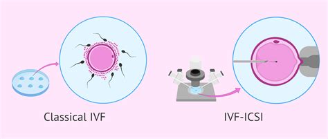 Infografika: Štatistika úspešnosti IVF a ICSI po 3 cykloch