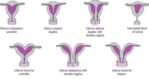 Infografika: Uterus bicornis - anatomické usporiadanie a rozdiely oproti normálnej maternici