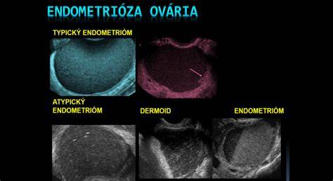 Obrázok: anatomická interpolácia maternice a endometria