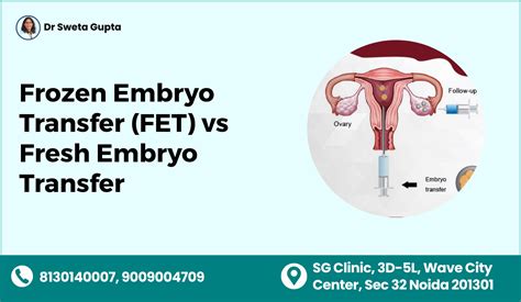 schematický obrázok: čerstvý transfer vs. kryoembryotransfer