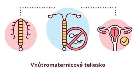 Vnútromaternicové teliesko Mirena: zavedenie, postup a informácie