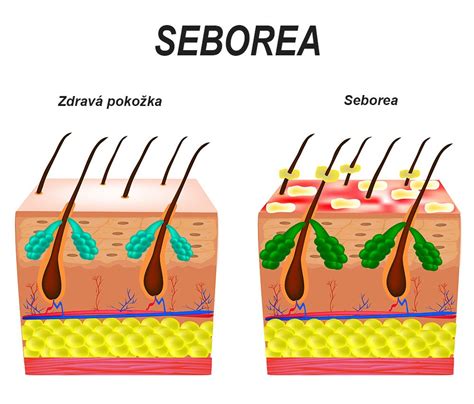 Porovnanie zdravej pokožky a pokožky s rôznymi typmi hyperpigmentácie
