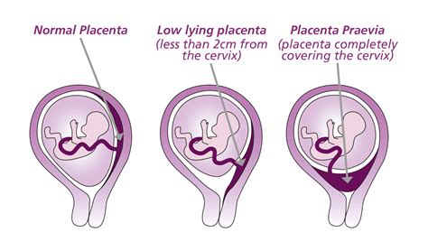 infografika o placente praevia a jej typoch