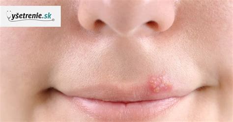Herpes na perách - príznaky a liečba