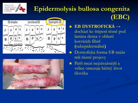 Epidermolysis Bullosa Congenita: Život s 