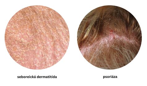 Schéma porovnávajúca seboreu a psoriázu