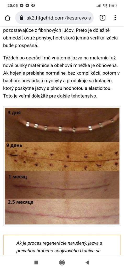 Schéma rekonvalescencie po cisárskom reze