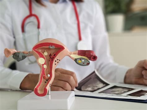 Ilustrácia laparoskopie pri diagnostike endometriózy